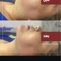 ساکشن غبغب ۳/۵۰۰تومن|خدمات آرایشگری و زیبایی|مشهد, فرهنگ|دیوار