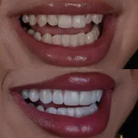 ارائه خدمات کامپوزیت ولمینیت دندان (ونیرکامپوزیت )|خدمات آرایشگری و زیبایی|کرج, مهرویلا جنوبی|دیوار