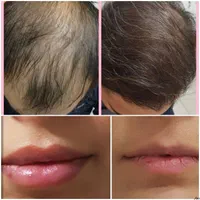 مطب پوست موزیبایی لیزرحذف تتوبالیزرQsبا۱۷سال تجربه