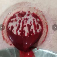 بادکش حرفه ای و حجامت