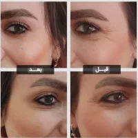 بوتاکس ژل صورت و بدن|خدمات آرایشگری و زیبایی|بیرجند, |دیوار