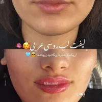 تخفیفات استثنایی ژل و بوتاکس در مطب زیبایی|خدمات آرایشگری و زیبایی|قم, زنبیل آباد|دیوار