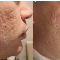 خداحافظی با چال‌های جوش و جای زخم با تکنیک سابسیژن