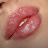 ورکشاپ اقتصادی مزوژل .مزوتراپی . بوتاکس
