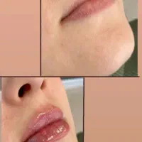 تخفیف بوتاکس در کلینیک زیبایی