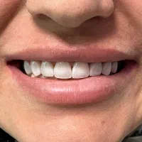 کامپوزیت ونیر با شرایط اقساطی( رزرو تا ۱۵اسفند )