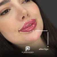 تزریق تخصصی انواع فیلر و بوتاکس (دکتر پورامیدی)