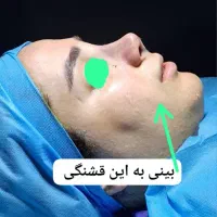 بلفاروپلاستی با۲تومن تخفیف فقط فردا ۳عصر|خدمات آرایشگری و زیبایی|قم, بلوار امین و ساحلی|دیوار