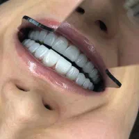 دندانپزشکی.کامپوزیت دندان .عصب کشی .لمینت.روکش|خدمات آرایشگری و زیبایی|تهران, تهرانپارس شرقی|دیوار