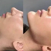 ژل/فیلر/فیشیال/پاکسازی/پوست ومولیزر|خدمات آرایشگری و زیبایی|کرج, گوهردشت|دیوار