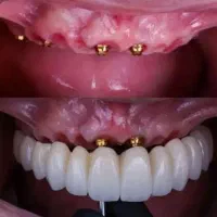 جشنواره دندانپزشکی و ایمپلنت طرف قرارداد با بیمه|خدمات زیبایی و سلامت|تبریز, |دیوار