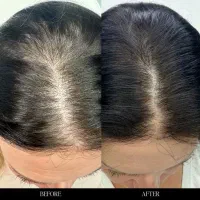 حل ریزش (تضمینی)