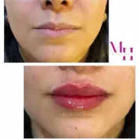 تزریق ژل و بوتاکس|خدمات آرایشگری و زیبایی|قم, صدوق|دیوار