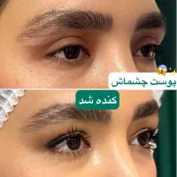 بلفاروپلاستی جراحی پلک بالا و پایین