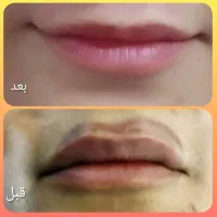 ریموو تتو با لیزر کیوسوییچ|خدمات آرایشگری و زیبایی|خرم‌آباد, |دیوار