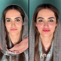 تزریق فیلر ژل/بوتاکس/prp پوست مو/پی آر‌پی/مزوتراپی|خدمات آرایشگری و زیبایی|کرج, گوهردشت|دیوار