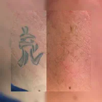 پاک کردن تتو .لیزر.پاککردن خالکوبی .ریموو تتو.prp|خدمات آرایشگری و زیبایی|اصفهان, خلجا|دیوار