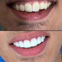 دندانسازی دندانپزشکی کامپوزیت فکی 10درمطب VlP|خدمات آرایشگری و زیبایی|رشت, استقامت ۱|دیوار