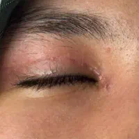 بلفاروپلاستی بدون اسکار و تضمینی فقط ۷/۵|خدمات زیبایی و سلامت|مشهد, کوثر|دیوار