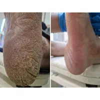 اموزش پدیکور تخصصی