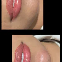 جشنواره آفر ویژه ژل سیسی 770 و بوتاکس 900|خدمات زیبایی و سلامت|شیراز, رازی|دیوار
