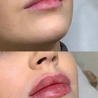تزریق ژل بوتاکس مزو جوانساز|خدمات آرایشگری و زیبایی|وحیدیه, |دیوار