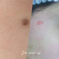 مزونیدلینگ کل صورت و پاکسازی وخالبرداری وآموزش|خدمات آرایشگری و زیبایی|یزد, |دیوار