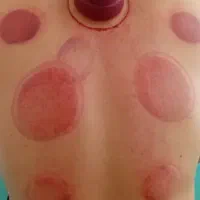 حجامت درمانی