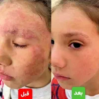 درمان پیسی وپسو ریازیس واگزما دائمی|خدمات آرایشگری و زیبایی|سمنان, |دیوار