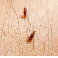 مایع رفع شپش مو|آرایشی، بهداشتی، درمانی|کرج, شهر صنعتی|دیوار