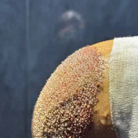 کلینیک تخصصی کاشت مو و ابرو در رشت