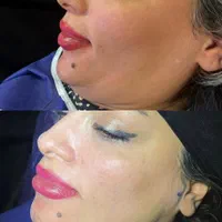 ساکشن غبغب/شکم پهلو/۳۶۰درجه/با دستگاه پال|خدمات آرایشگری و زیبایی|اسلام‌شهر, شهرک مفیدی|دیوار
