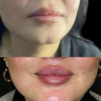 دوره ژل وبوتاکس نخ فیلربادی|خدمات آموزشی|تهران, جمهوری|دیوار