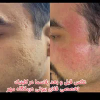لیزر موهای زاید روشن سازی پاک کردن تتو دردرمانگاه|خدمات آرایشگری و زیبایی|شیراز, حافظیه|دیوار