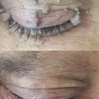 حذف لک و خال در یک جلسه|خدمات آرایشگری و زیبایی|پاکدشت, حصار امیر|دیوار