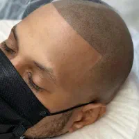 میکرو اسکالپ موی سر ،ریش، ابرو( در محل)|خدمات آرایشگری و زیبایی|تهران, سعادتآباد|دیوار