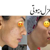 تزریق ژل بوتاکس چربیسوزی آنزیم جوانسازی|خدمات آرایشگری و زیبایی|اهواز, کیانپارس |دیوار