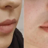 تزریق فیلر و بوتاکس توسط پزشک در کلینیک زیبایی|خدمات آرایشگری و زیبایی|قم, نیروگاه|دیوار