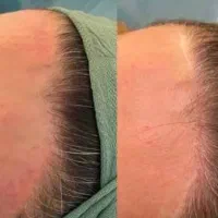 رفع جای بخیه/ترک پوستی/‌تیرگی