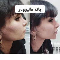 بوتاکس ژل فیلر فیلربادی مزوتراپی پی آر پی در مطب|خدمات آرایشگری و زیبایی|زنجان, |دیوار