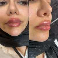 کرمپودر دائم و ژل و بوتاکس و هایفو|خدمات آرایشگری و زیبایی|اهواز, کیانپارس |دیوار