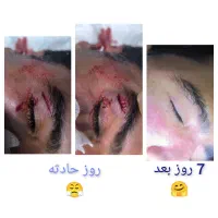 لیفت شقیقه،جای زخم(اسکار) بلفاروبوتاکس فیلر|خدمات آرایشگری و زیبایی|اهواز, زیتون کارگری|دیوار