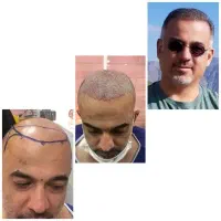 کلینیک کاشت مو و ابرو همسا