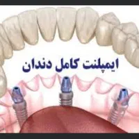 ایمپلنت دندان همه مدل 8800