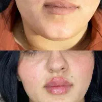 تزریق فیلر|خدمات آرایشگری و زیبایی|الشتر, |دیوار