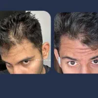 بمب پرپشتی ریش و مو