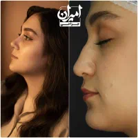 جراحی بینی با شرایط ویژه|خدمات آرایشگری و زیبایی|مرودشت, شهرک مهدیه|دیوار