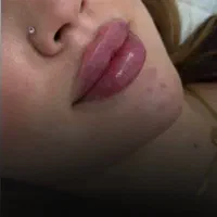 آفر فیلر بوتاکس رفع تیرگی،لک،جوانسازی،تتو،ریموتتو