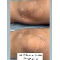 رفع تیرگی،آلگاپیل،لک صورت، پرسینگ، ژل صورت|خدمات آرایشگری و زیبایی|شیراز, سلطان آباد|دیوار