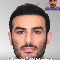 کاشت مو، کاشت ابرو، کاشت ریش،کاملا طبیعی
